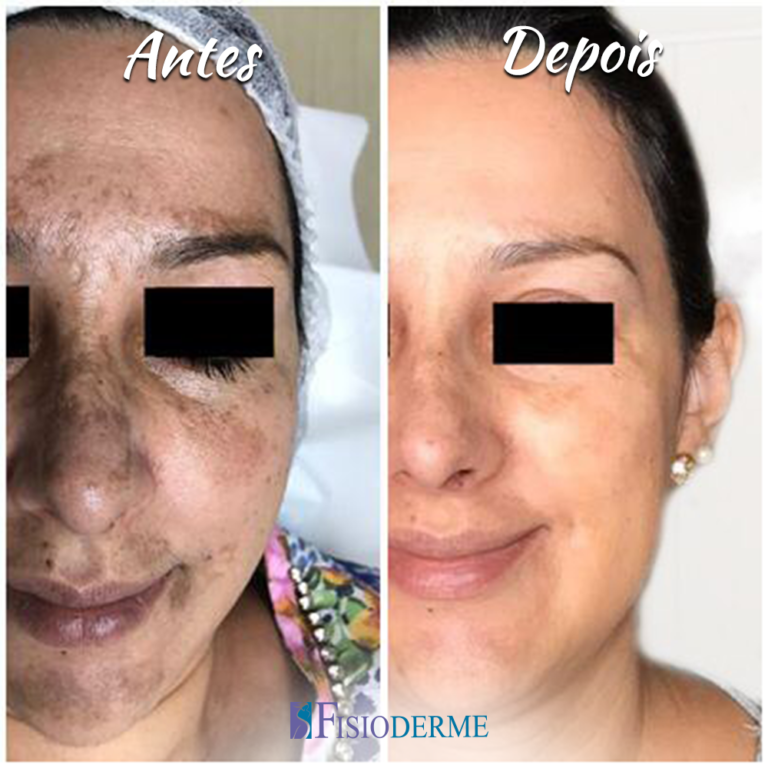 Melasma - Clínica Fisioderme em Brasília / DF - Candangolândia e Asa Sul