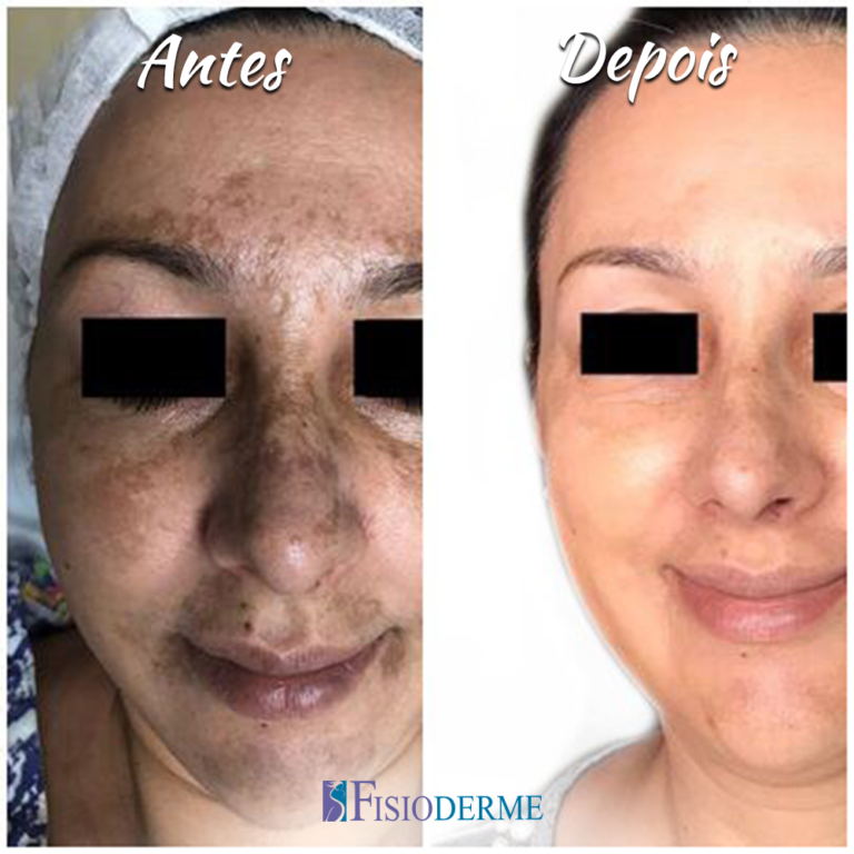 Melasma - Clínica Fisioderme em Brasília / DF - Candangolândia e Asa Sul
