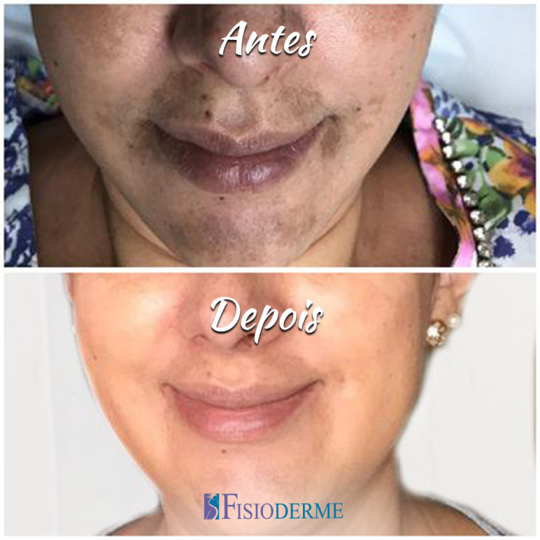 Melasma - Clínica Fisioderme em Brasília / DF - Candangolândia e Asa Sul