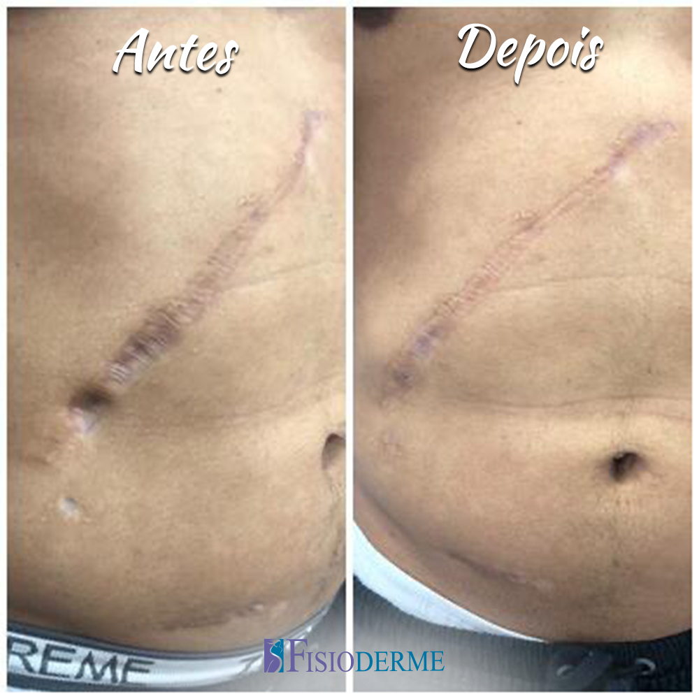 Mastopexia Cicatriz Fotos Antes E Depois Tratamento a laser (Cutera) de Cicatrizes Hipertróficas e Quelóide