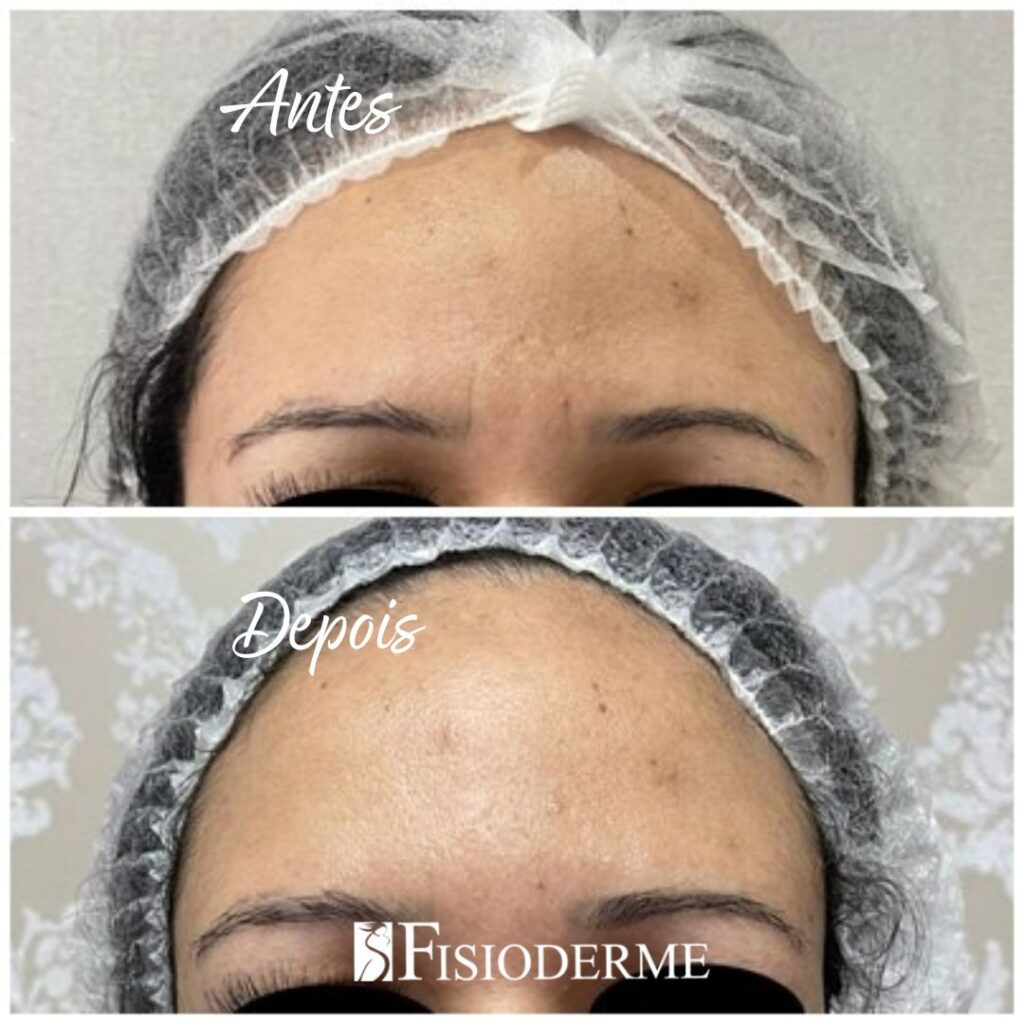 Resultado do tratamento de rugas na glabela antes e depois na Fisioderme Brasília DF