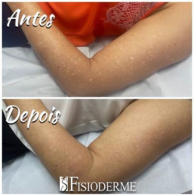 Leucodermia Solar Gutata ou Sardas Brancas em Brasília - DF