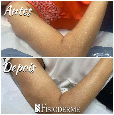 Leucodermia Solar Gutata ou Sardas Brancas em Brasília - DF