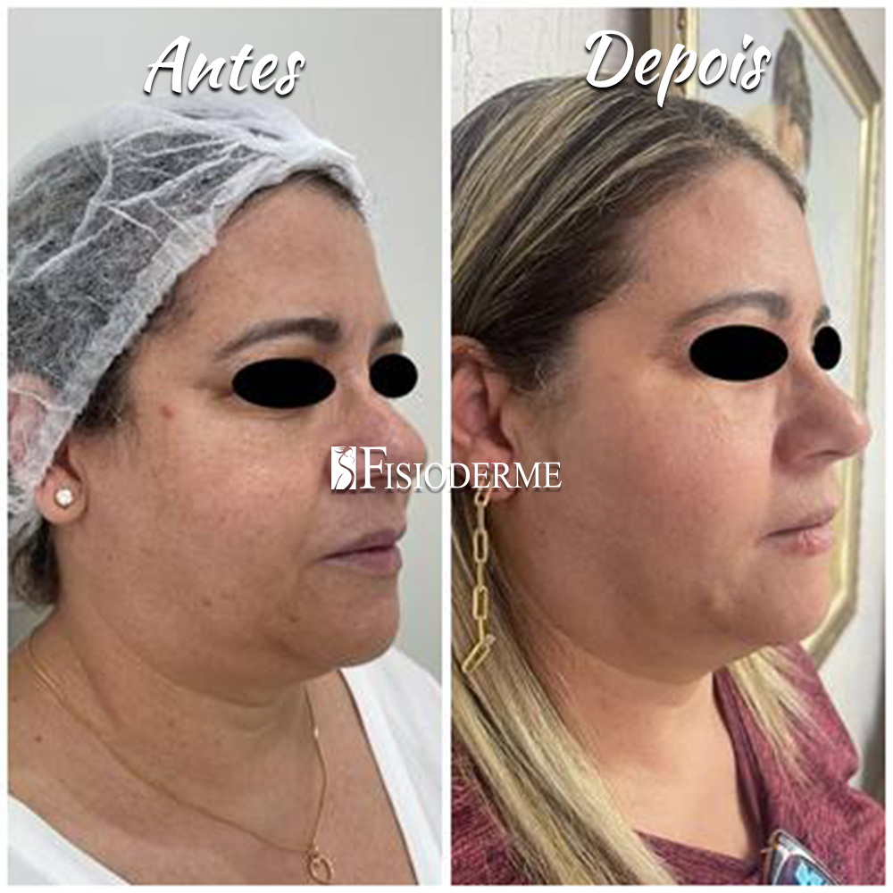 Antes e depois de preenchimento facial e fios de sustentação em Brasília