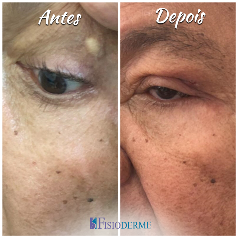 Resultado do tratamento para cisto sebáceo com remoção a laser – Clínica Fisioderme