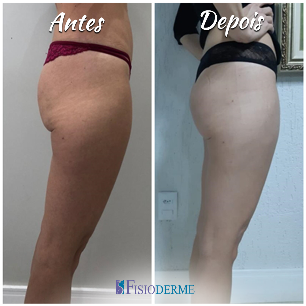 Imagem de bumbum empinado e firme após tratamento com bioestimuladores de colágeno