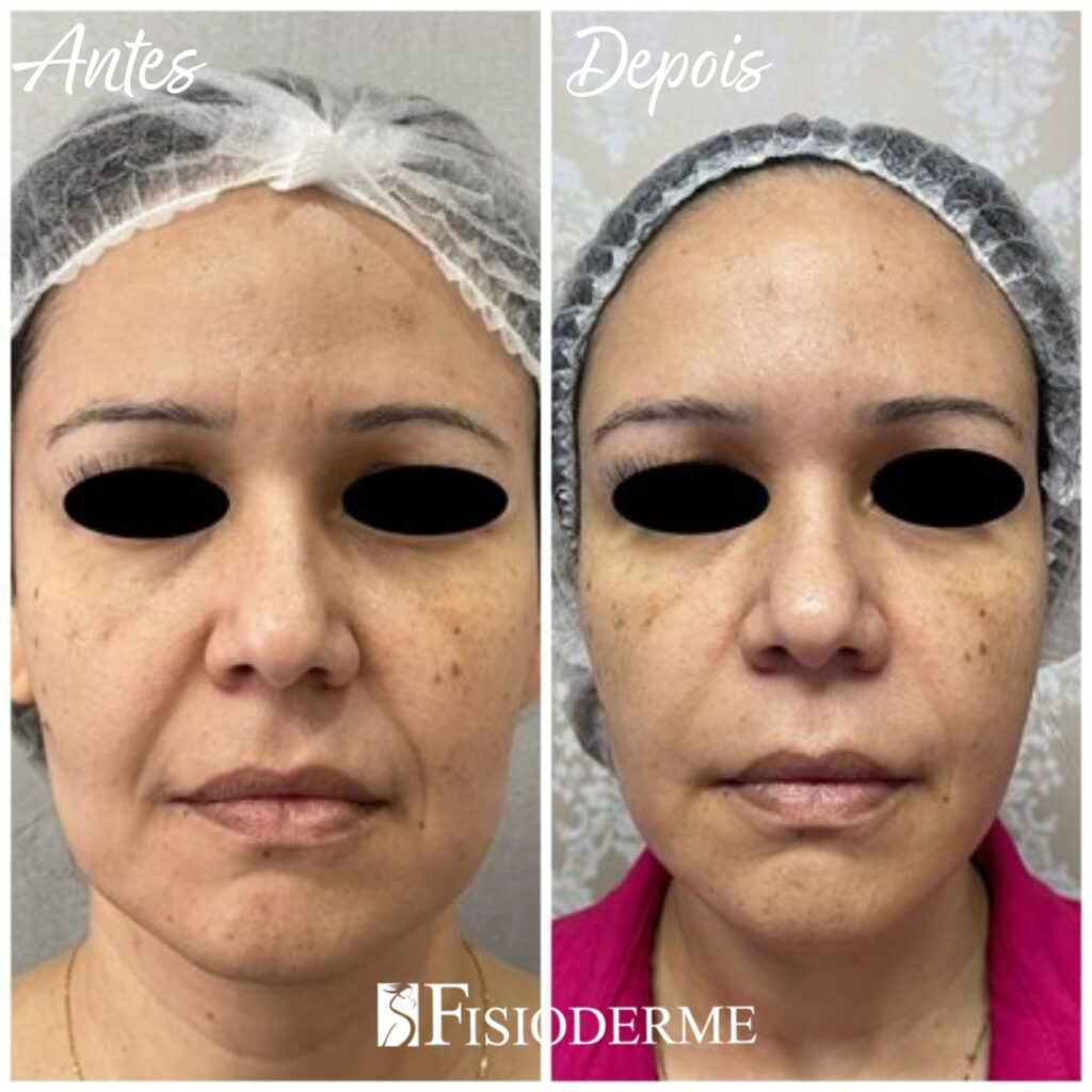 policaprolactona bioestimulador natural para rejuvenescimento da pele