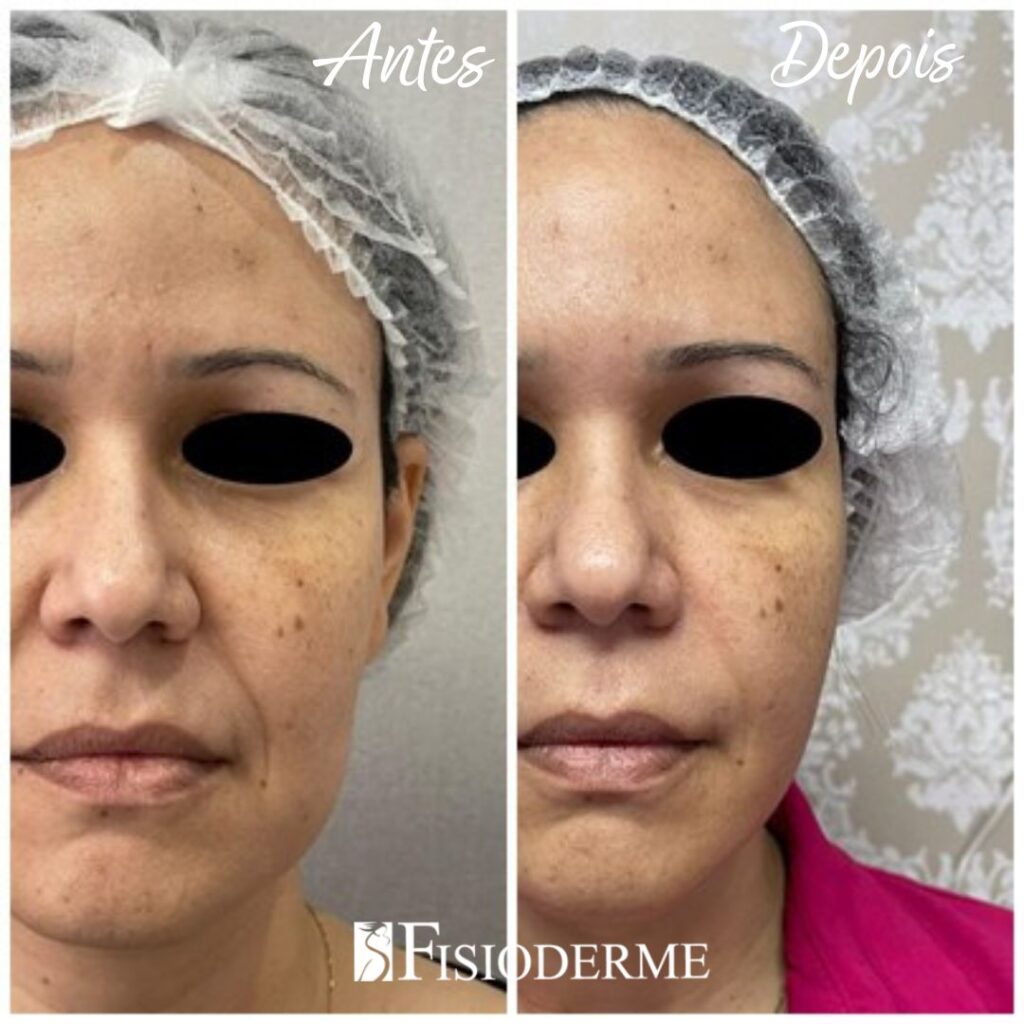 policaprolactona bioestimulador natural para rejuvenescimento da pele