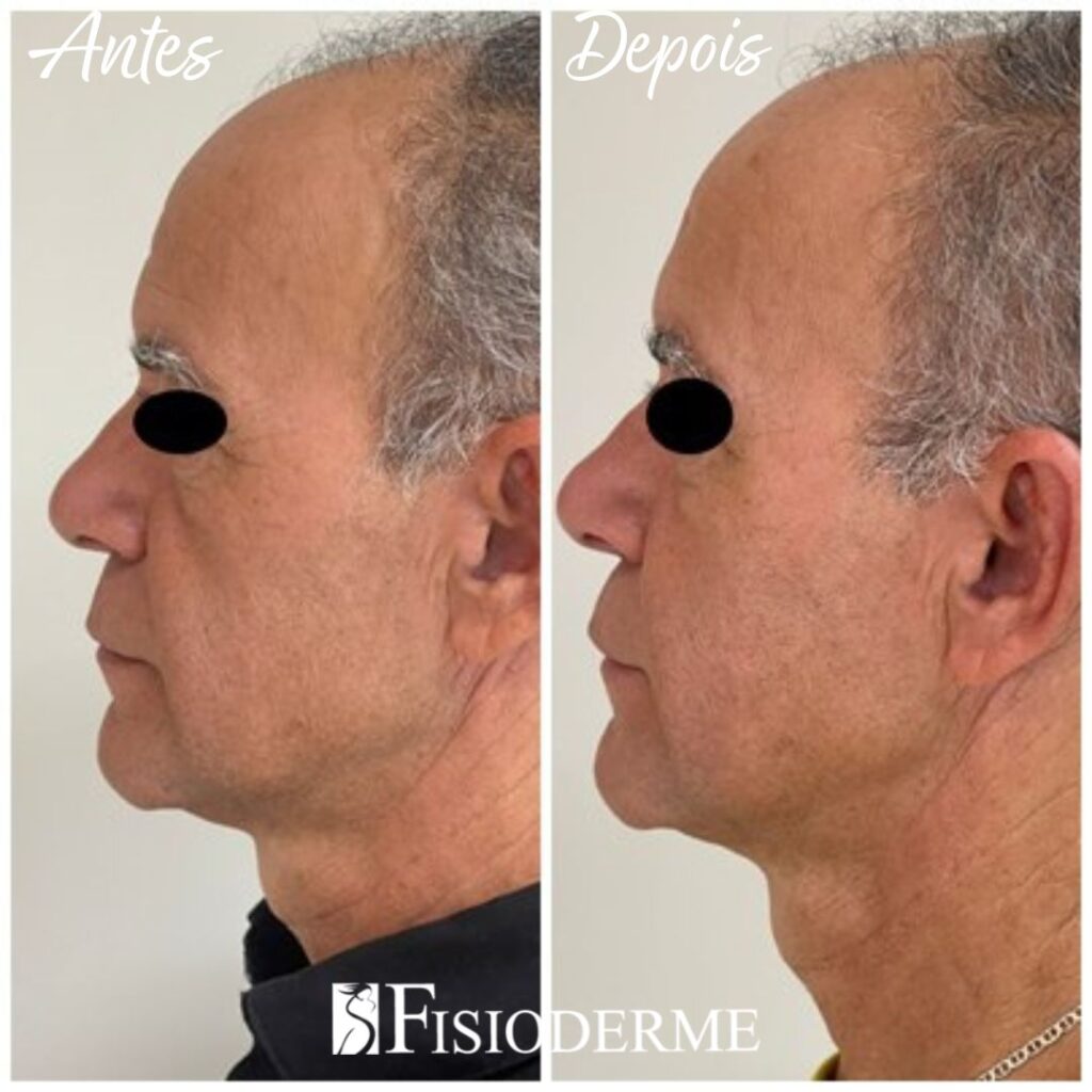 Preenchimento do sulco malar Fisioderme