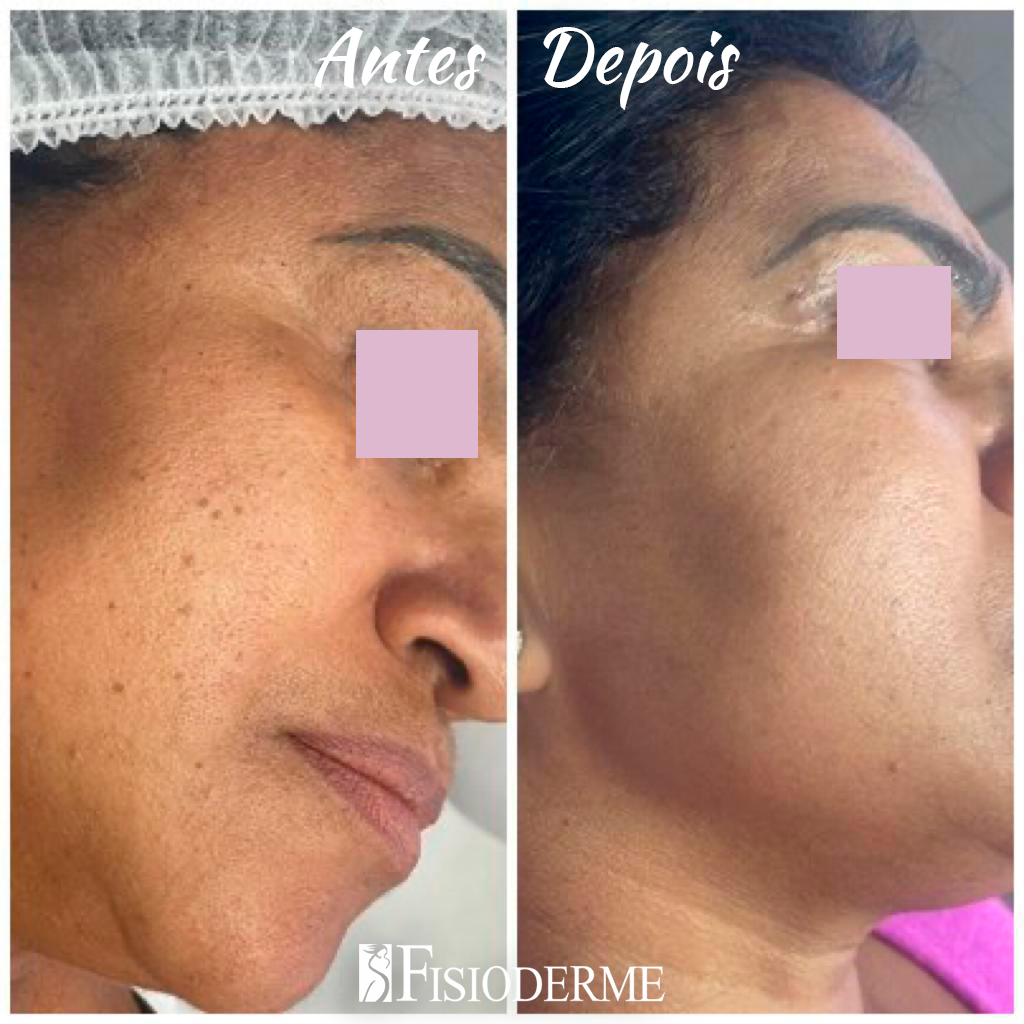 Paciente sorridente após tratamento seguro de remoção de pintas na Clínica Fisioderme