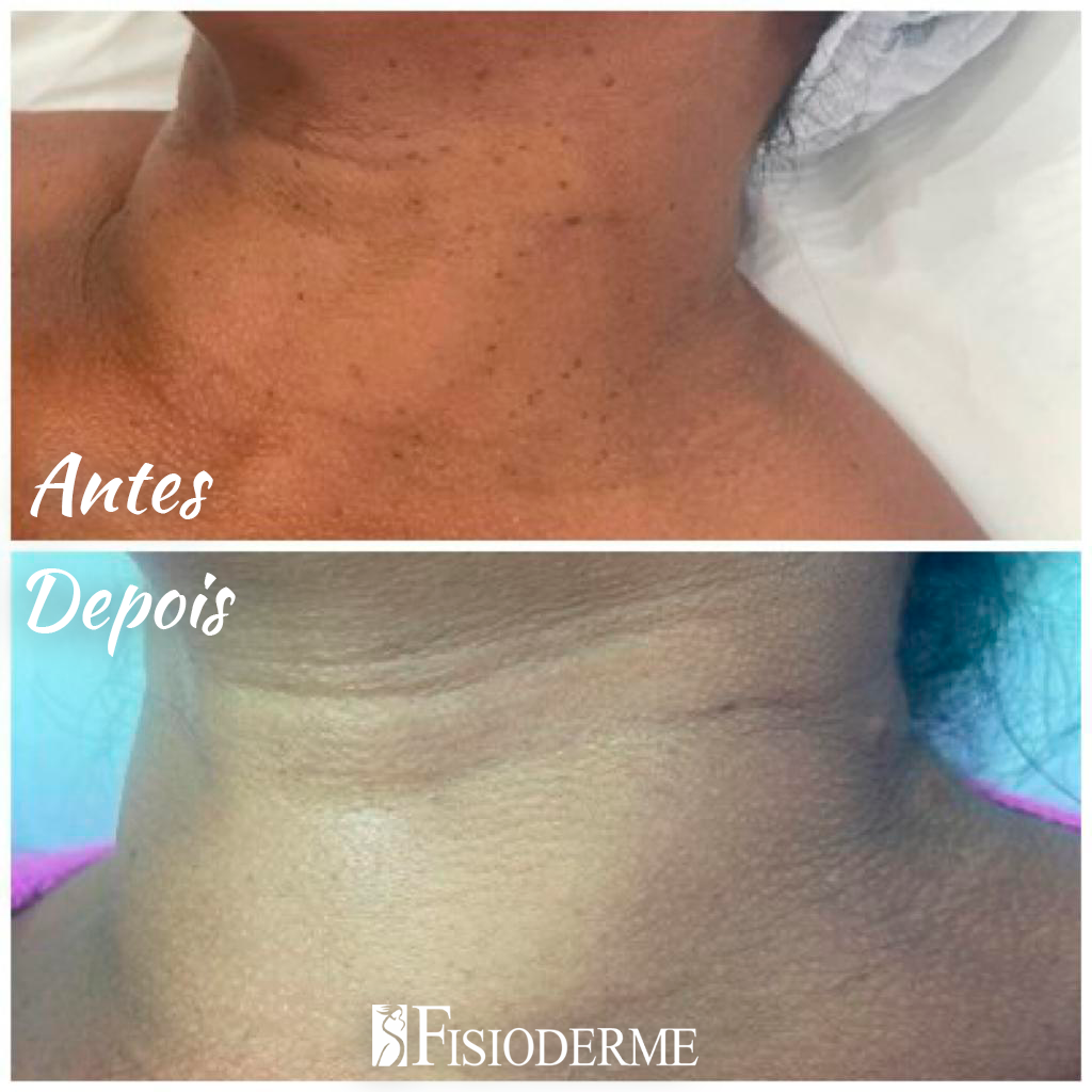 Paciente sorridente após tratamento seguro de remoção de pintas na Clínica Fisioderme