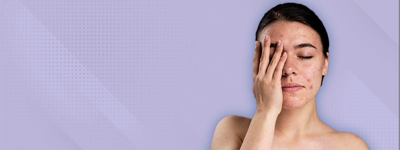 Um Guia Completo sobre Cicatrizes de Acne / Clínica Fisioderme / Brasília