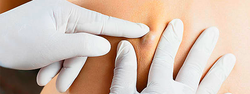 Perguntas Frequentes sobre Cisto Sebáceo ou Epidermóide - Fisioderme