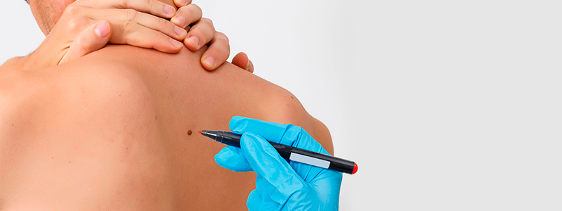 Livre-se de Imperfeições: Remoção de Verrugas, Nevos, Sinais e Pintas a Laser ou com Plasma